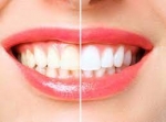 Does Teeth Whitening Work on Crowns and Veneers?
