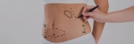 Tummy Tuck Scars: What to Expect in Islamabad