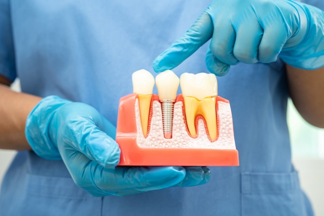What Makes Dental Implants the Preferred Choice in Torrance