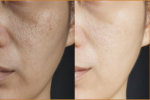 How a Lower Face Lift in Los Angeles Enhances FacialContours
