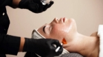 chemical peels