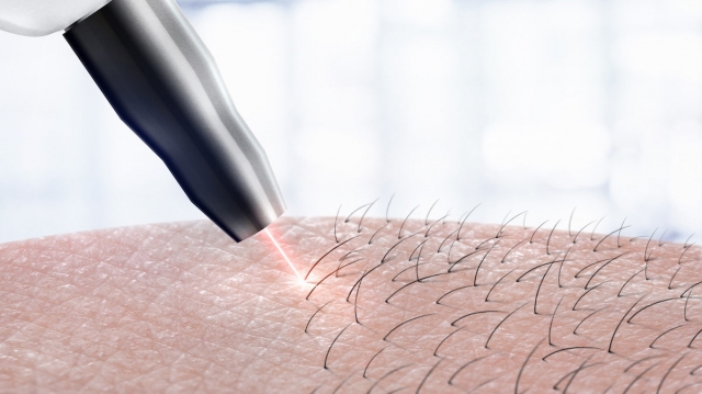 What Factors Can Affect Laser Hair Removal Success and Efficiency