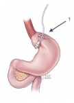 Exactly what does bariatric surgery mean?