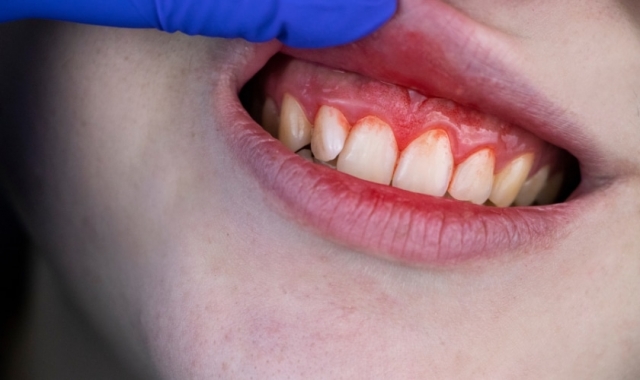 Can Gum Contouring Be Done with Braces?