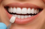 How Much Do E-max Veneers Cost in Dubai?