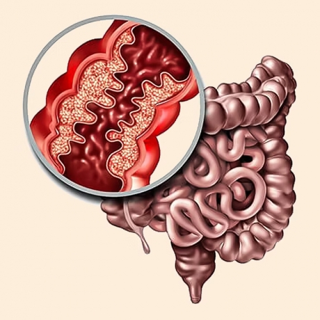 Restoring Gut Balance, the Ayurvedic Way