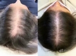 PRP Hair Treatment in Islamabad – A Natural Approach to Hair Regrowth