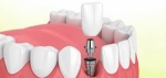 Dental Implant Treatment: How Much Do Dental Implants Cost in India?