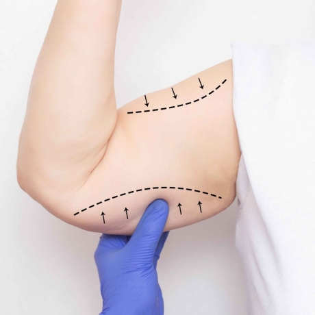 Can an Arm Lift Help Achieve Slimmer and More Toned Arms?