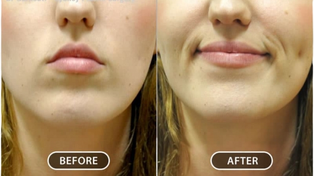 Expert Surgeons for Dimple Creation Surgery at Jaipur’s Trusted Hospital