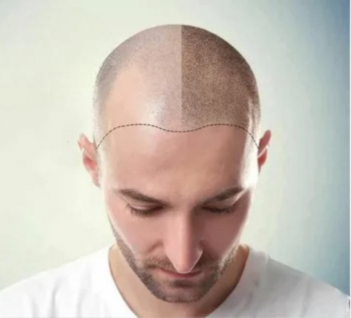 Best hair transplant clinic in F7, Islamabad