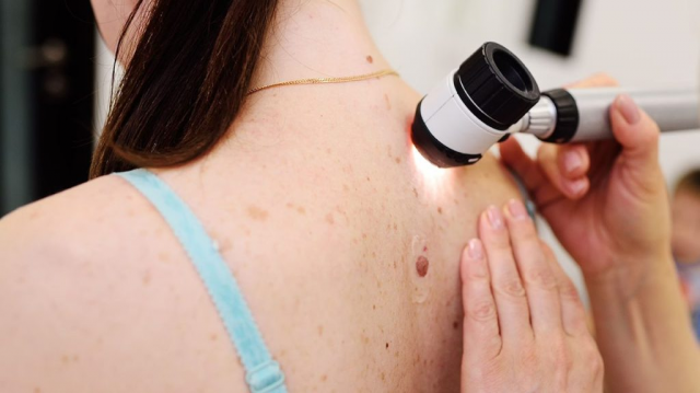 Is Dermoscopy Effective for All Types of Moles?