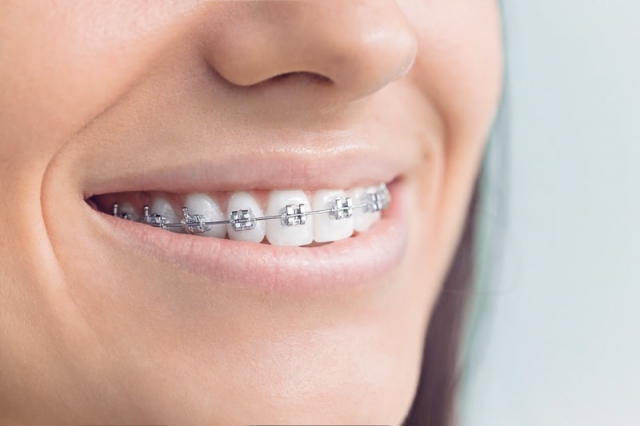 7 Reasons Why You Should Opt For Ceramic Braces in Dubai