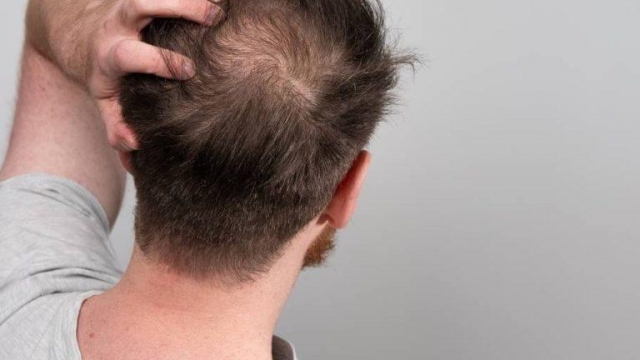 Lifestyle Changes to Complement Hair Loss Treatments for Men