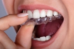 How Invisalign in Fort Collins is Redefining Modern Orthodontics