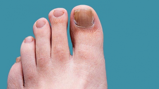 What is Over the Counter Treatment for Nail Fungus Infection