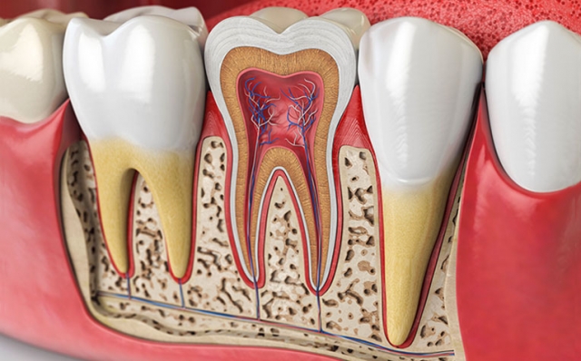 What Kind Of Tooth Pain Requires A Root Canal in Dubai