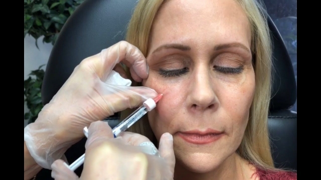 Can Dermal Fillers Restore Lost Volume Beneath Eyes?