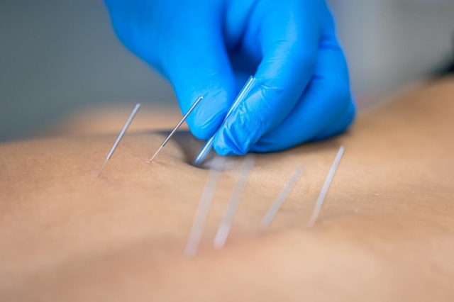 Why Dry Needling Is a Game Changer for Chronic Pain