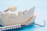 Dental Crowns: Restoring Strength and Beauty to Damaged Teeth