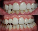 Teeth Scaling vs Deep Cleaning — What’s the Difference?