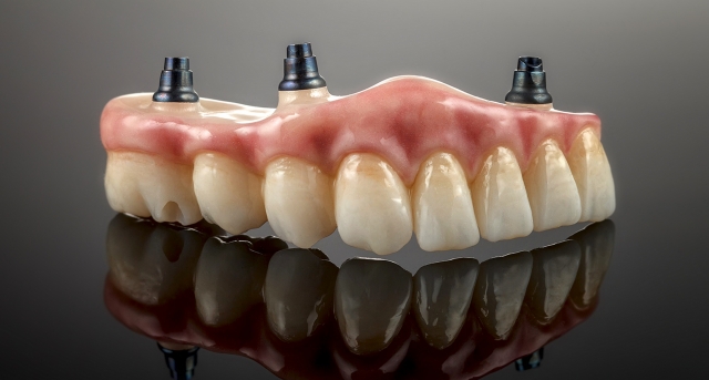 What Are the Steps in the All on 4 Dental Implants Procedure?