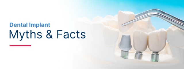 Implant Dentistry FAQs: Dispelling Myths And Misconceptions!