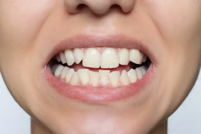 How Long Does Overlapping Teeth Treatment Take? A Timeline Overview