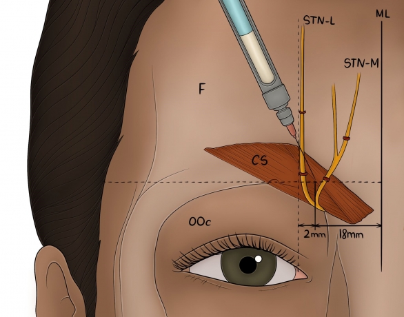 Botox and the Treatment of Chronic Migraines: Current Efficacy and Future Directions