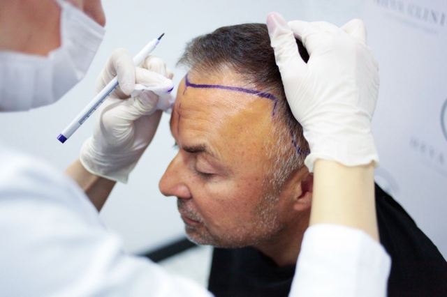 Looking for a Permanent Hair Solution? Try Hair Transplant in Dubai