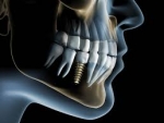 Innovations in Immediate Load Dental Implant Surgery: Efficiency and Efficacy Explored