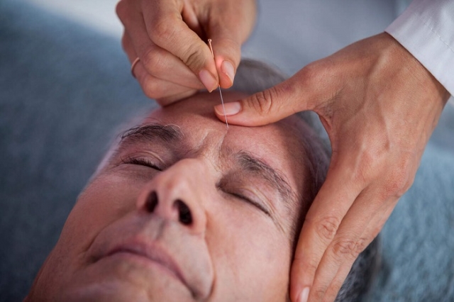 Can Acupuncture Reduce the Frequency and Severity of Chronic Migraines