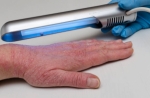Radiation Dermatitis Treatment Market Growth Fueled by Advanced Therapeutics