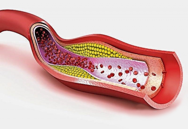 Hypercholesterolemia Market Growth Driven by Innovative Therapeutics