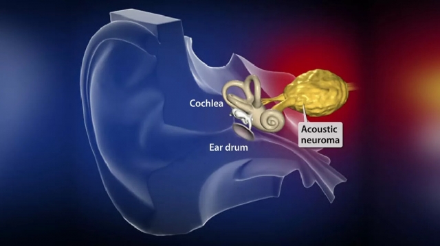 Acoustic Neuroma Market Size and Emerging Trends Driving Growth