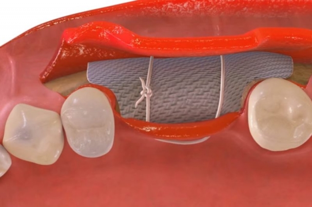 Dental Membrane and Bone Graft Substitute Market Growth Driven by Innovative Technologies