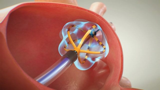 Pulsed Field Ablation Market Size Driving Rapid Growth Through Innovative Trends