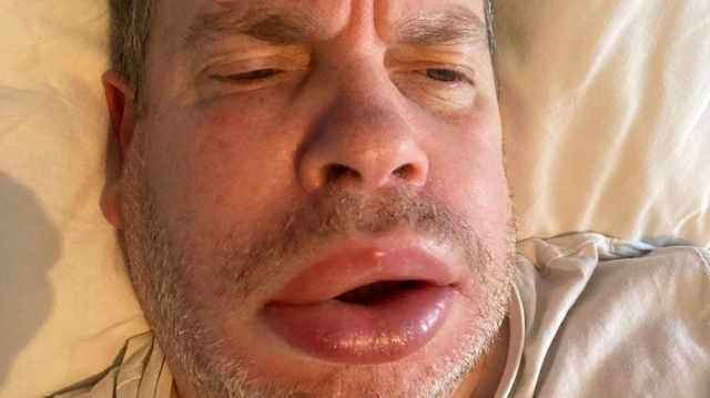 Hereditary Angioedema Market Growth Driven by Innovative Therapeutics