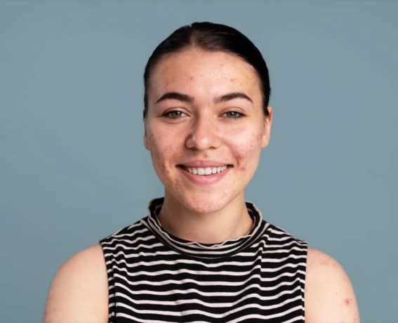 Effective Dermatological Treatments for Acne Scars