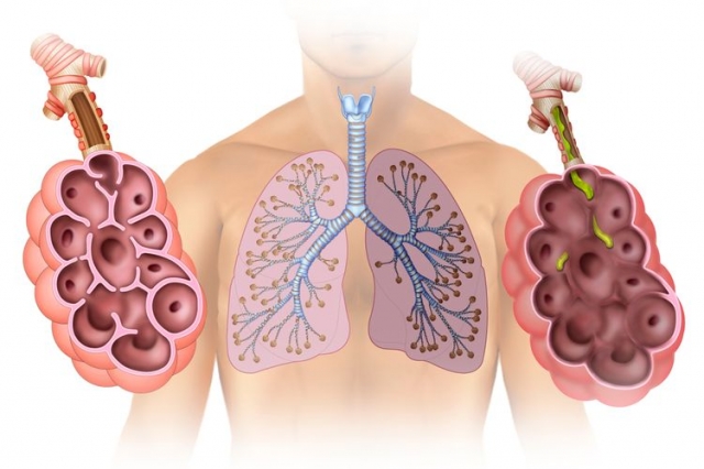 Emphysema Market Size and Growth Driven by Innovative Therapeutics