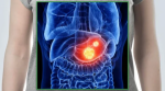 Gastrointestinal Stromal Tumor (GIST) Market Size and Emerging Growth Trends