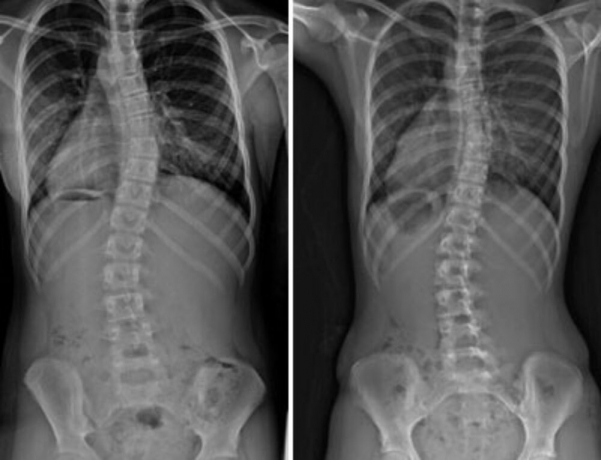 Scoliosis Management Market Size and Emerging Technological Trends