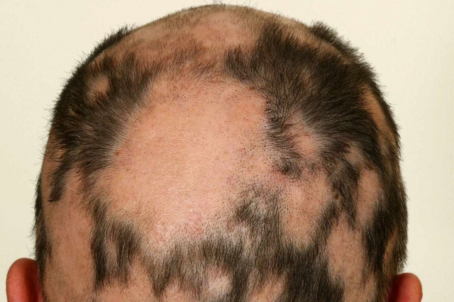 Alopecia Areata Treatment Market Size Expands with Innovative Growth Trends
