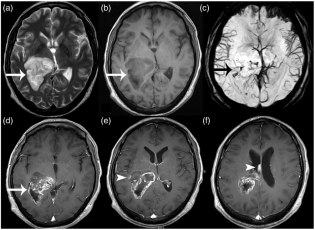Recurrent Glioblastoma Multiforme Treatment Market Size and Emerging Growth Trends