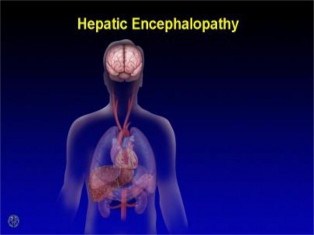 Hepatic Encephalopathy Market Growth Driven by Innovative Therapies