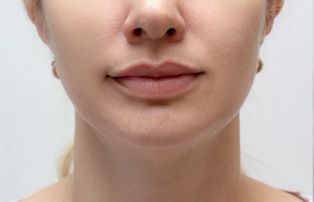 How long do nose fillers last?