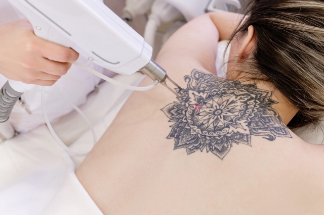 Ink Reversal: How Laser Tattoo Removal Can Give You a Clean Canvas