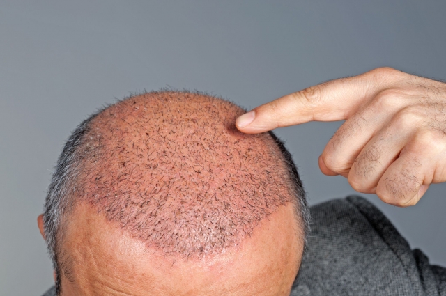 Beyond Baldness: Exploring the Latest Innovations in Hair Transplantation Techniques