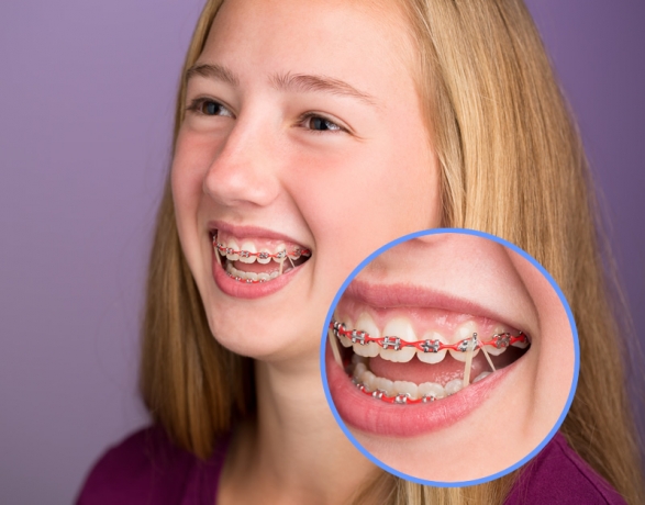 All You Need To Know About Invisalign Braces