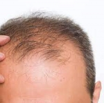 The Ultimate Guide to FUE Hair Transplant in Islamabad